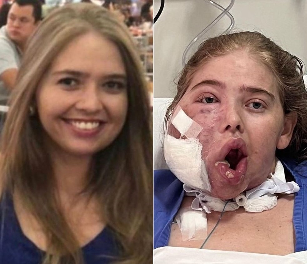 Jessica sofre com tumor que faz os vasos sanguíneos crescerem e se acumulare de forma excessiva — Foto: Divulgação