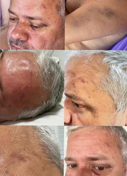 Prefeito de Ceará-Mirim exibe hematomas após discussão com deputado | Fotos: Reprodução